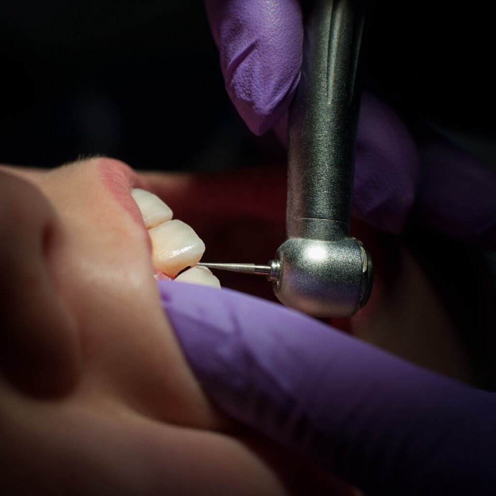 Implantes dentales en Algeciras