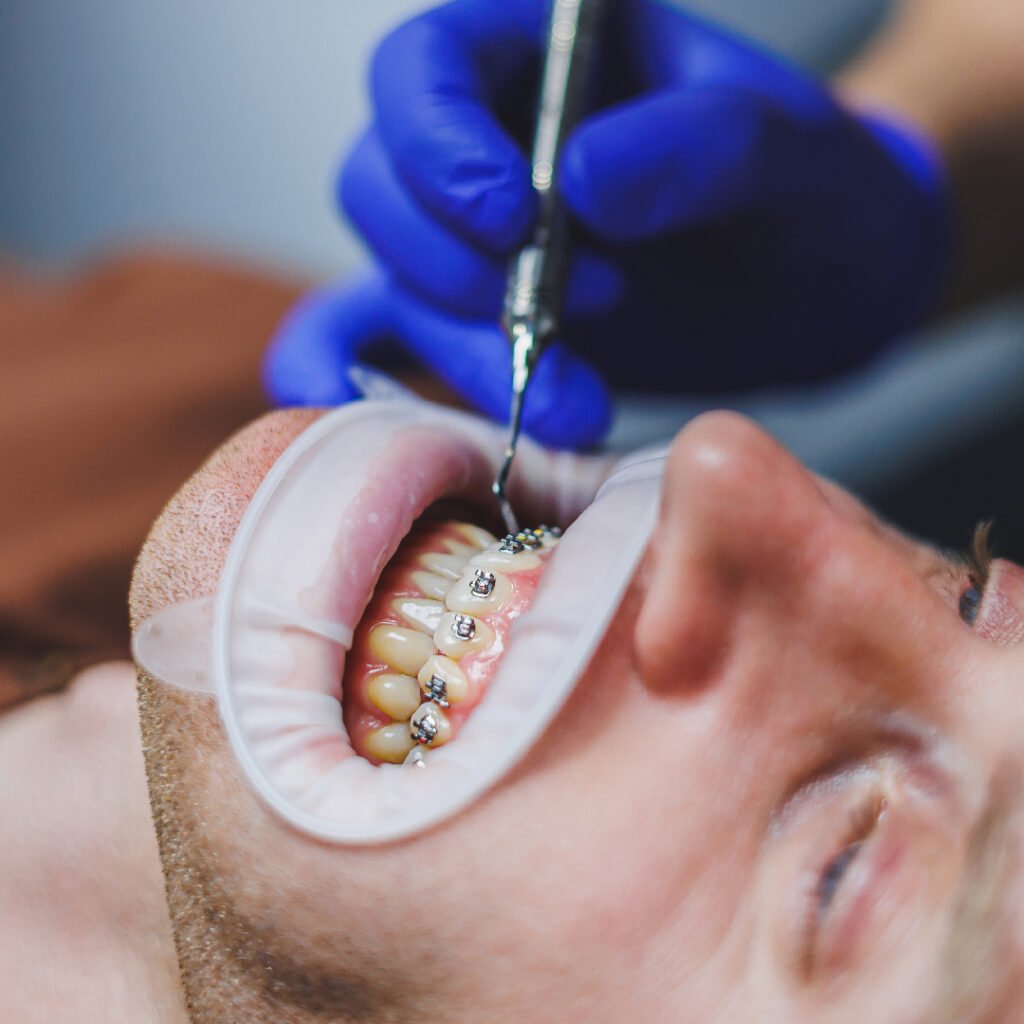 Ortodoncia Invisible en Algeciras