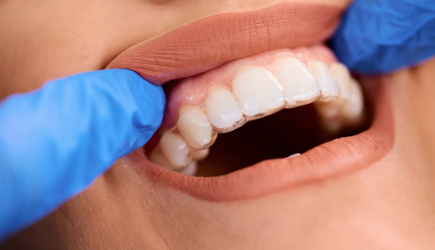 Ortodoncia invisible para adultos solución estética