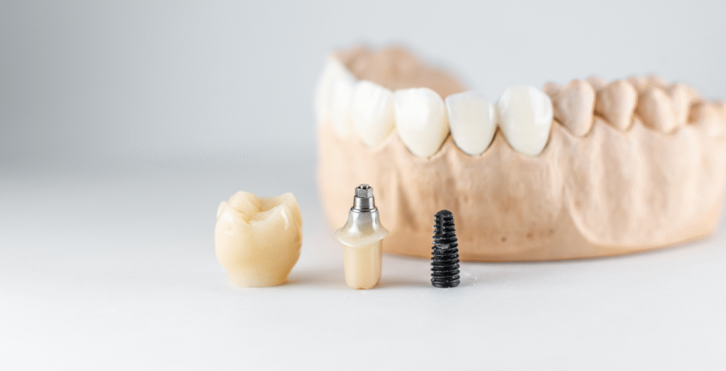 Edad ideal para colocarse implantes dentales sin riesgos