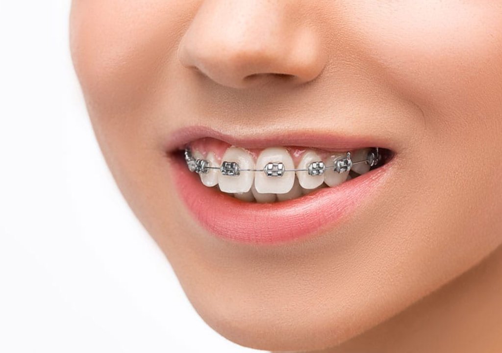 Ortodoncia infantil en Algeciras