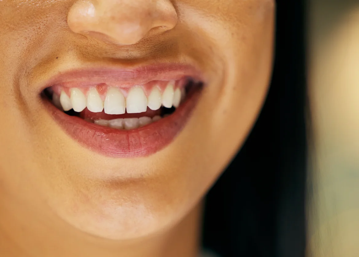 Beneficios clave de los implantes dentales