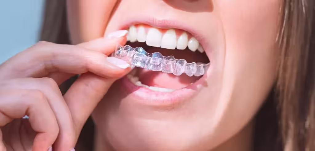 Precio de Invisalign en Algeciras